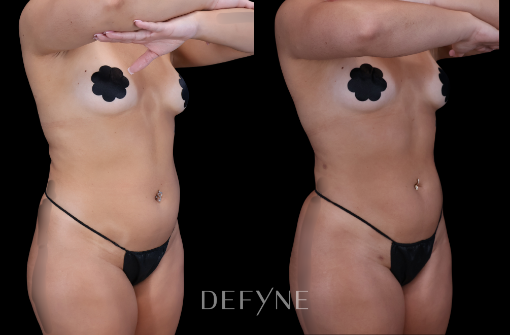 Before and after — S.M.A.R.T. Tummy Tuck, Patient #2079, view 2
