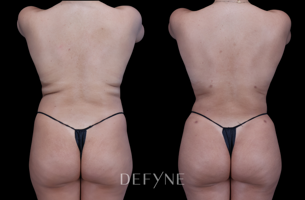Before and after — S.M.A.R.T. Tummy Tuck, Patient #2079, view 3