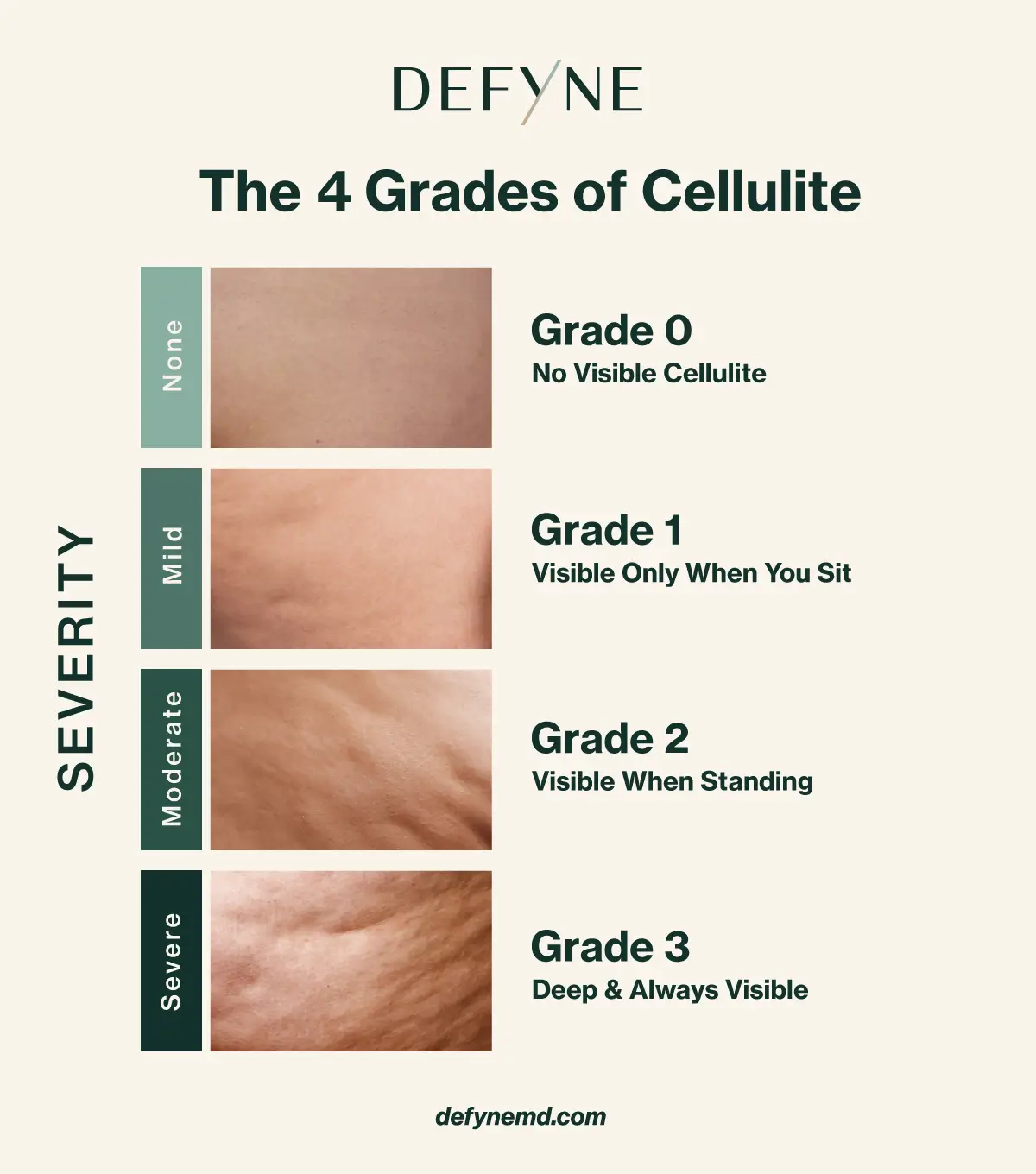 4 grades of cellulite