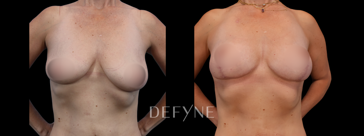 Before and after — Breast Lift with Fat Grafting (True Form), Patient #241