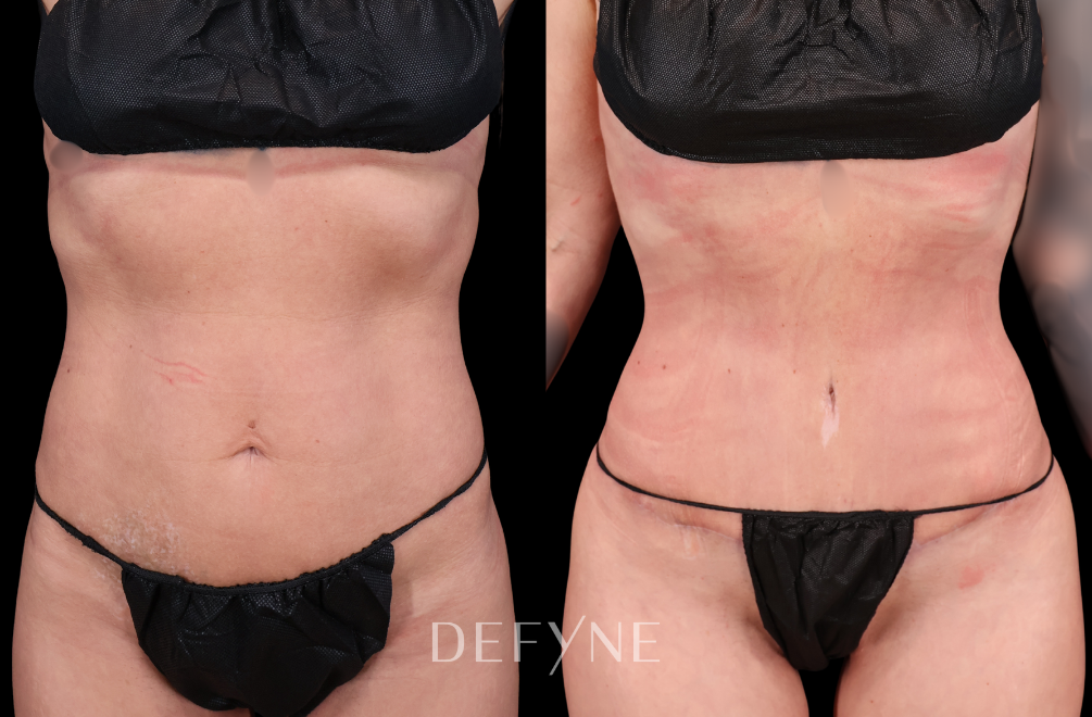 Before and after — Tummy Tuck, Patient #4799