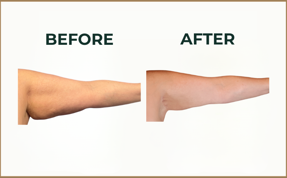 arm lift before and after