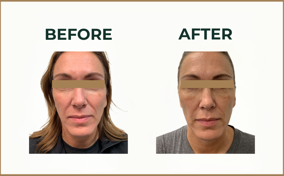 fat grafting before and after