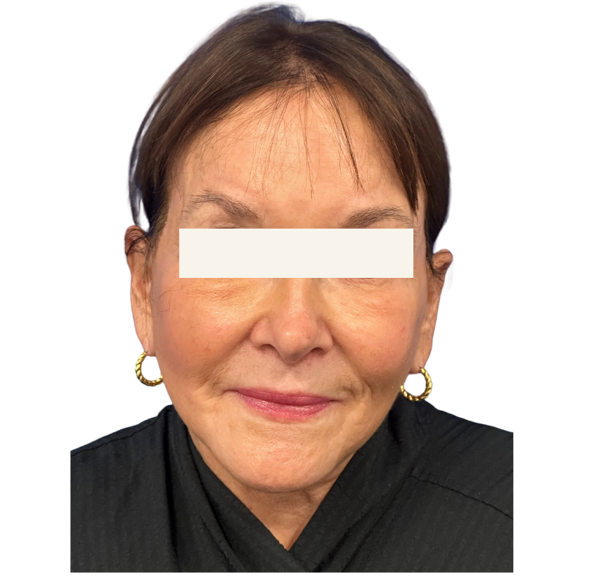 facelift after