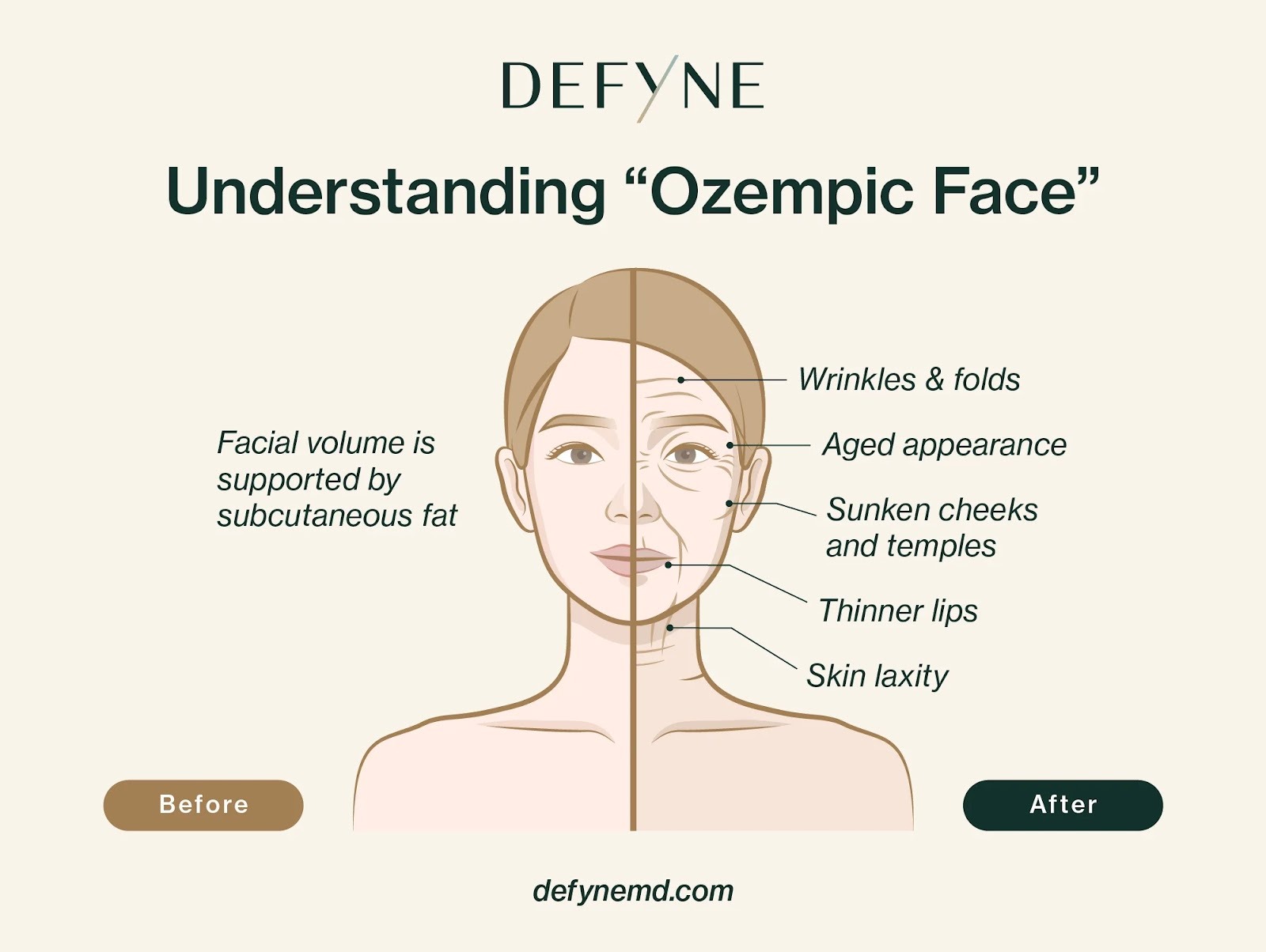 before vs after "Ozempic face"