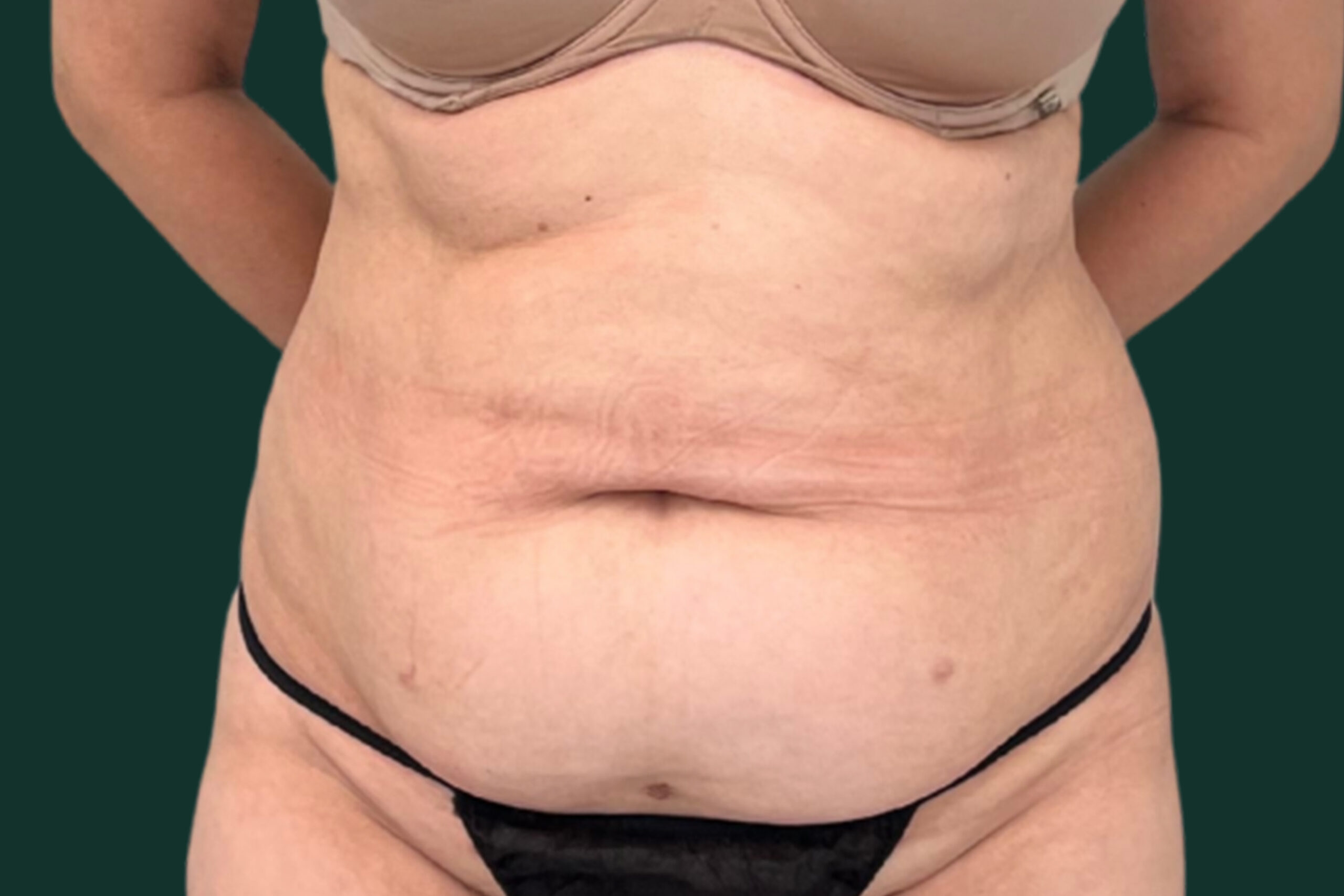 before-body-scaled
