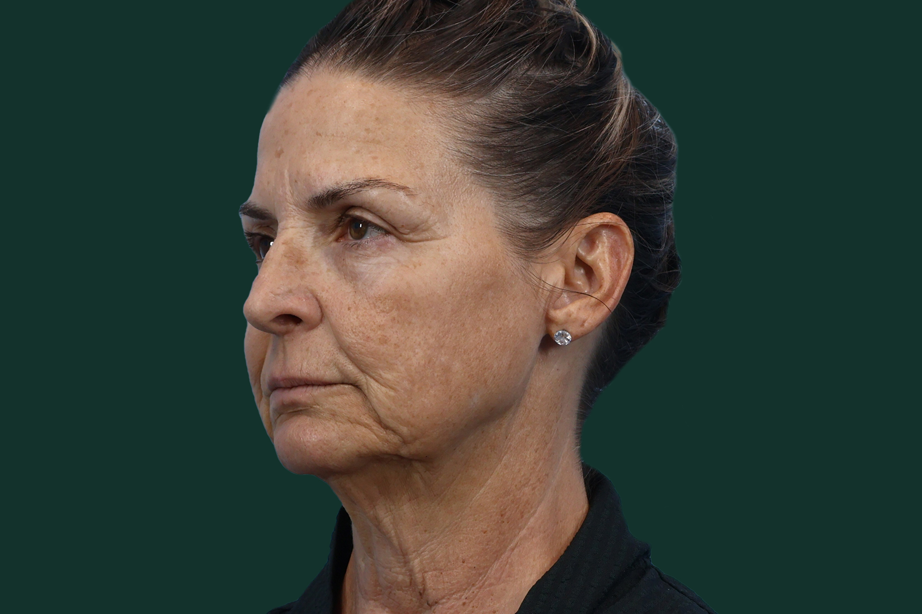 before-image