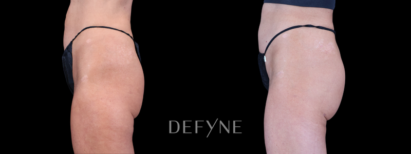 Before and after — AlloClae (Body), Patient #4748