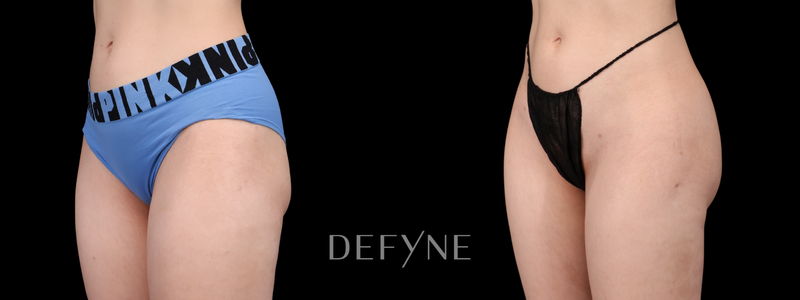 Before and after — AlloClae (Body), Patient #3665, view 2