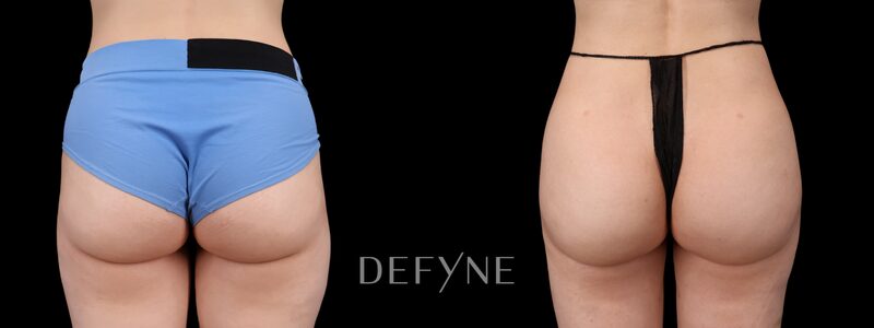 Before and after — AlloClae (Body), Patient #3665, view 3
