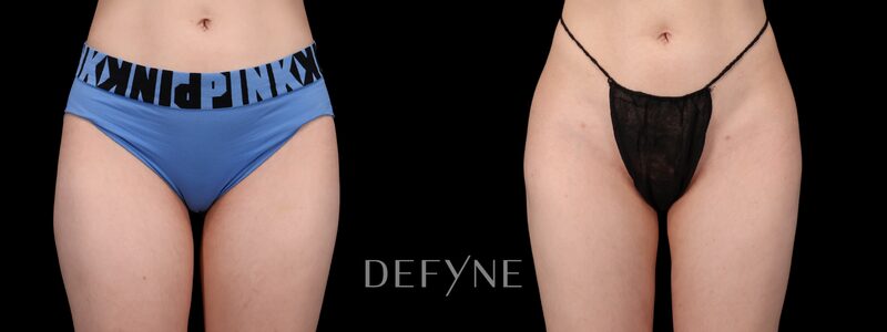 Before and after — AlloClae (Body), Patient #3665
