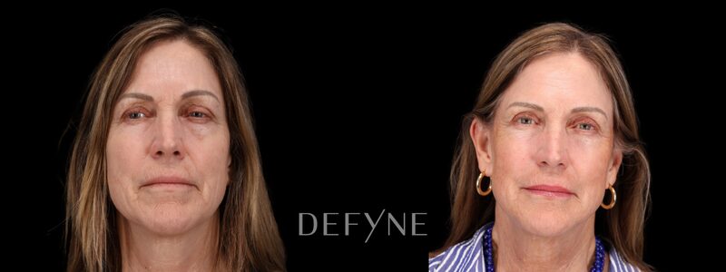 Before and after — Blepharoplasty, Patient #2870