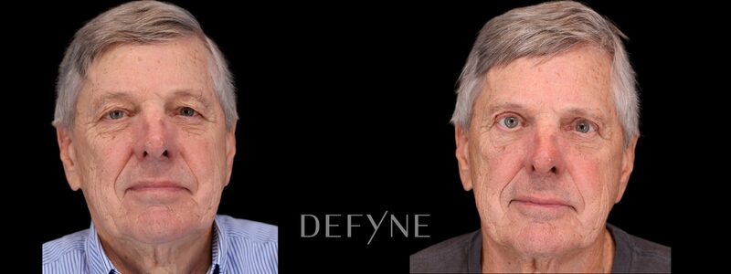 Before and after — Blepharoplasty, Patient #5498
