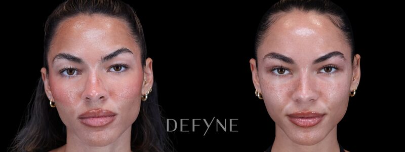 Before and after — Blepharoplasty, Patient