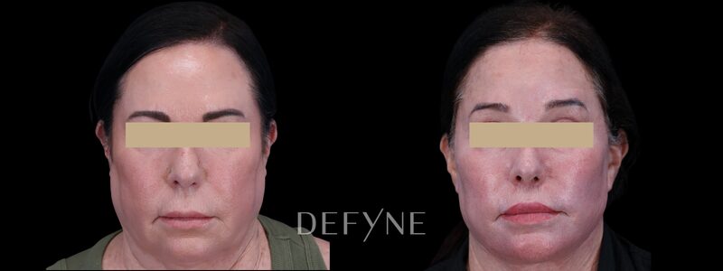 Before and after — Facelift, Patient #4813