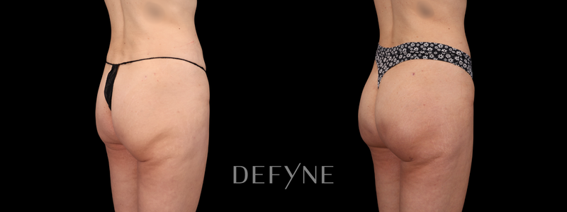 Before and after — True Curve BBL, Patient #2633, view 2