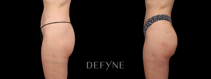 Before and after — True Curve BBL, Patient #2633