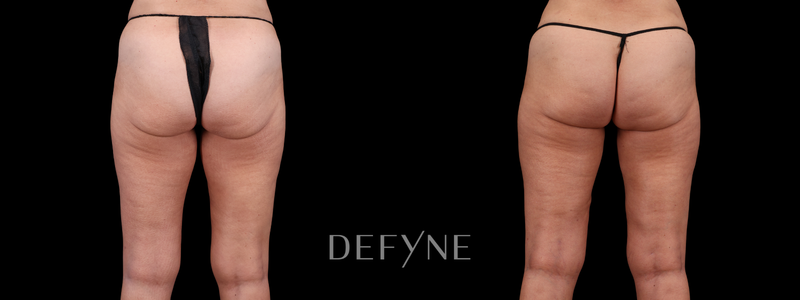 Before and after — Thigh Lift, Patient #5119