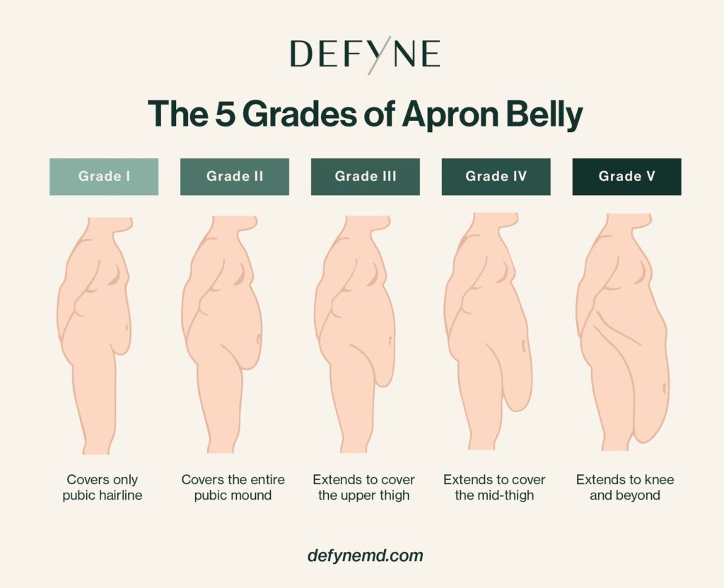 The 5 Grades of Apron Belly