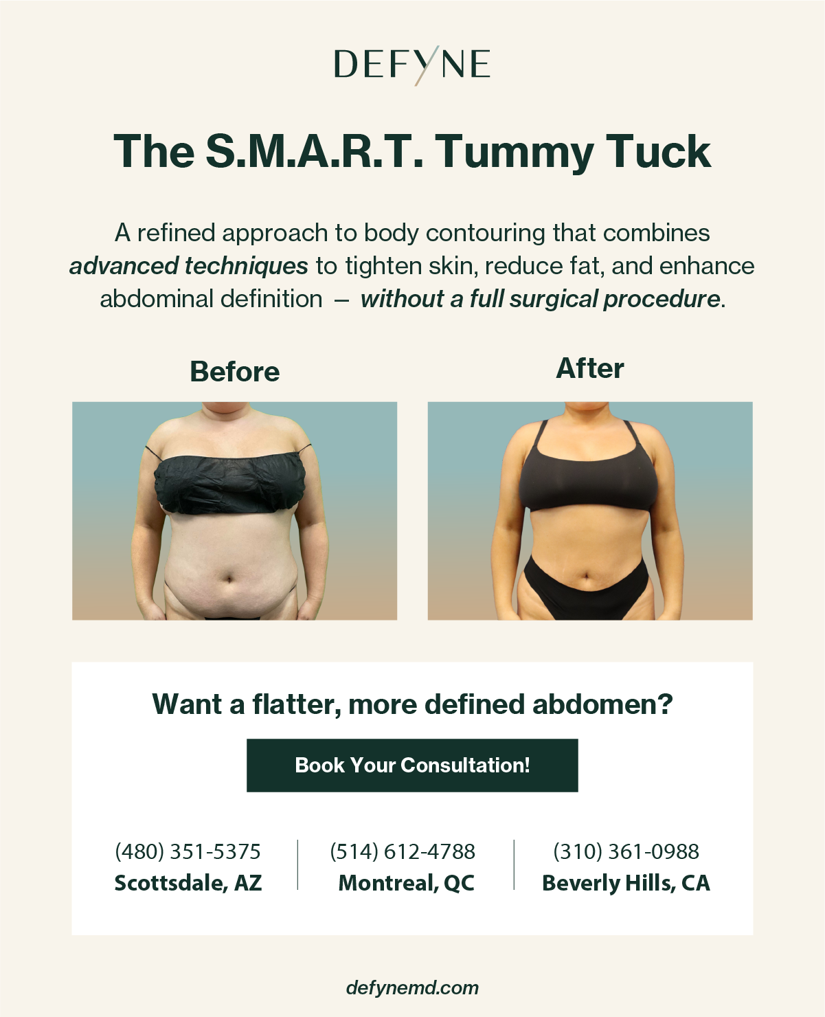 S.M.A.R.T. Tummy Tuck before and after