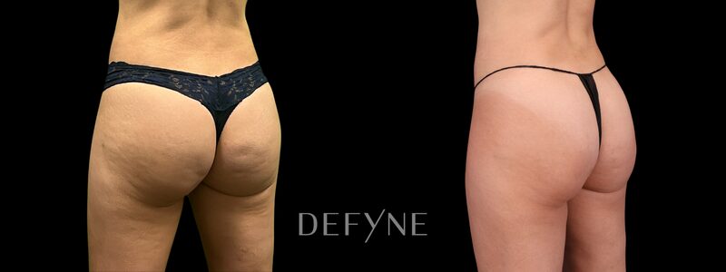 Before and after — Cellulite Treatment, Case 1, view 3