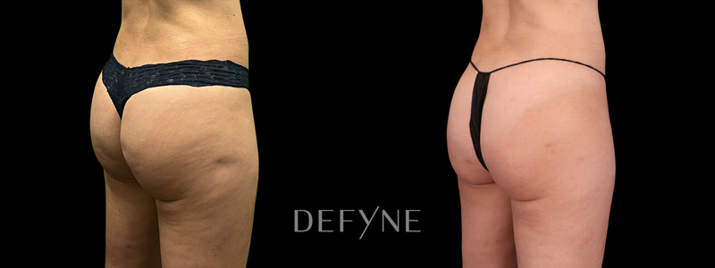 Before and after — Cellulite Treatment, Case 1, view 2