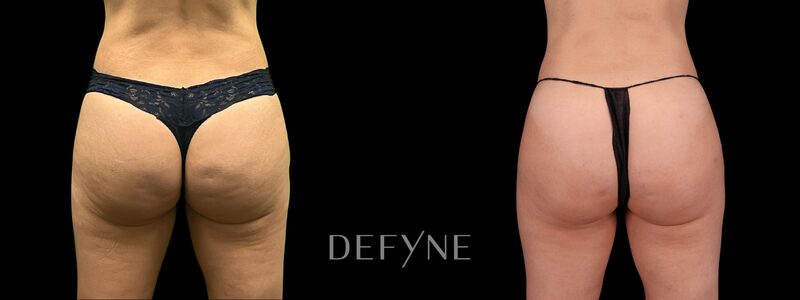 Before and after — Cellulite Treatment, Case 1