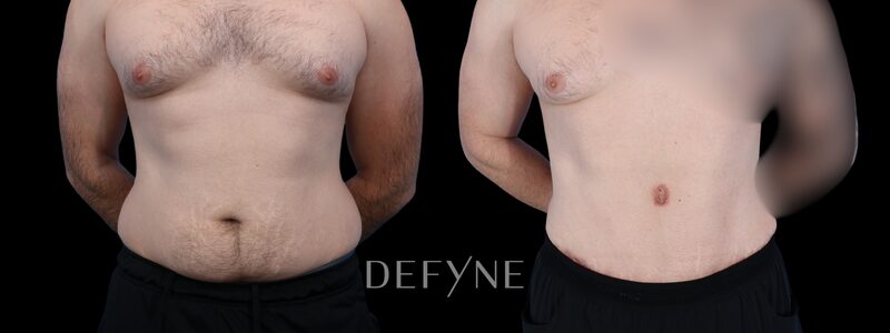 Before and after — Male Tummy Tuck, Patient #3250, view 2