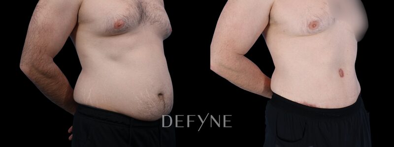 Before and after — Male Tummy Tuck, Patient #3250, view 3