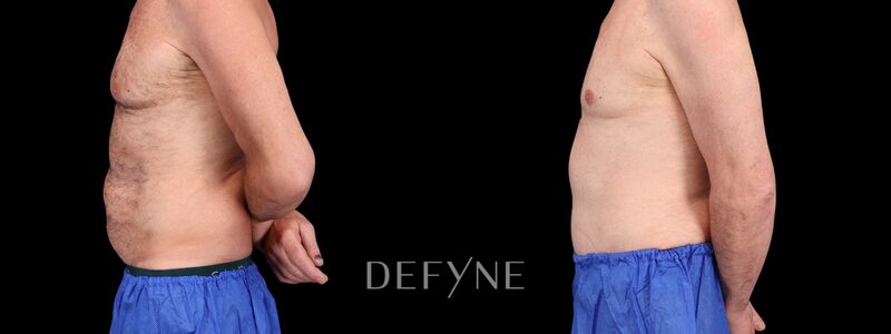 Before and after — Male Tummy Tuck, Patient #3505