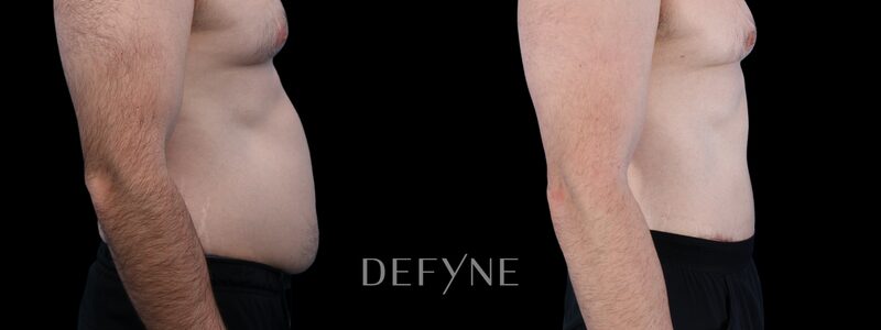 Before and after — Male Tummy Tuck, Patient #3250